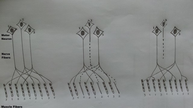 Gambar 1. Inervasi dan denervasi pada serat otot. Disalin dari Fig. 2.2 buku Mitsumoto (2009)